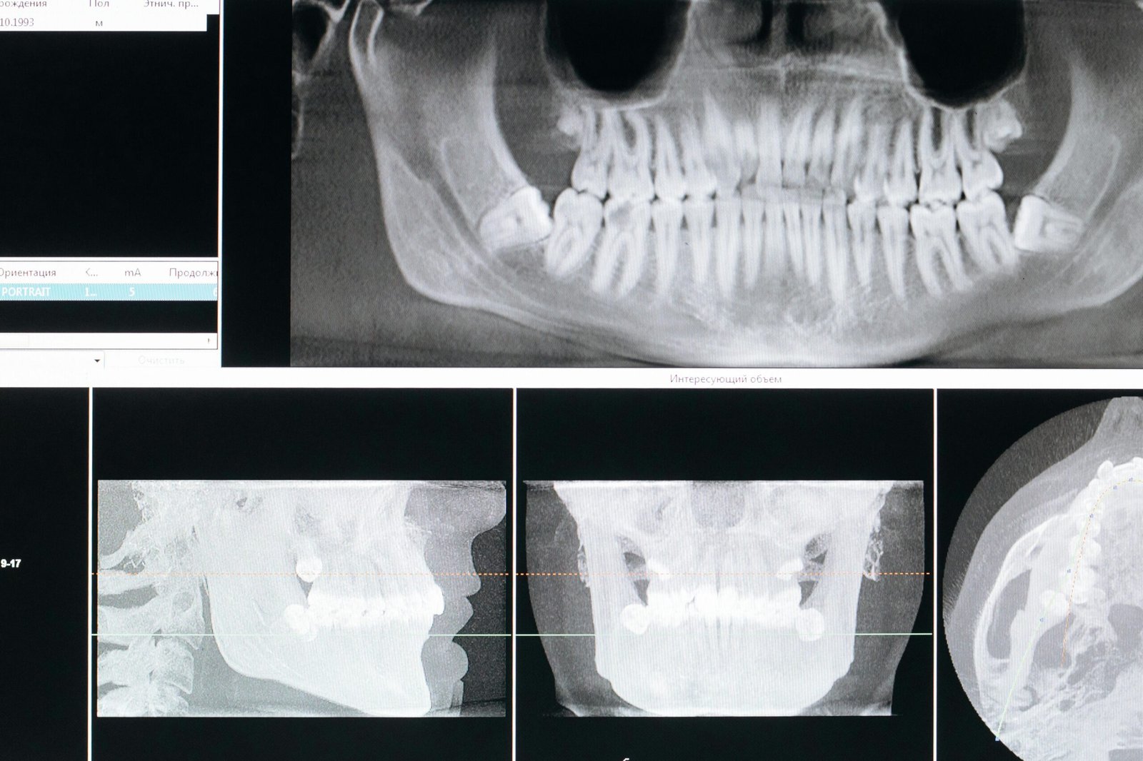 Do You Need a Bone Graft for a Dental Implant? Process and Costs