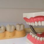 Dental Bridge vs. Implant: Comparing Longevity, Cost, and Comfort